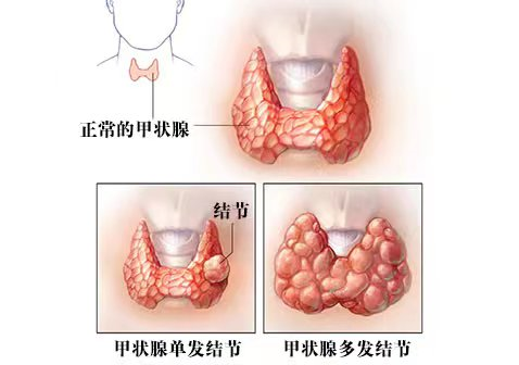 【健康科普】甲状腺结节知多少